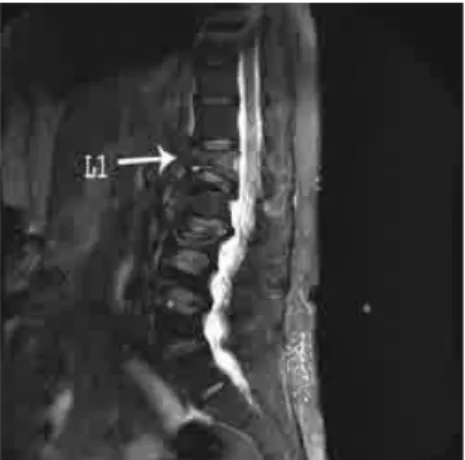 Gambar 2.11. MRI Fraktur Kompresi Lumbal 1  c.  CT- Scan 