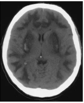 Gambar 2 CT scan pada hari ke lima menunjukkan adanya perdarahan pada  putamen. 9