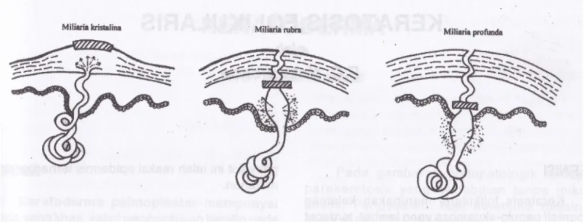 Gambar 1. Klasifikasi Miliaria berdasarkan letak obstruksi saluran keringat 