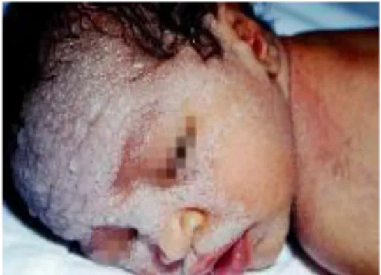 Gambar 3. Kristalina pada newborn 