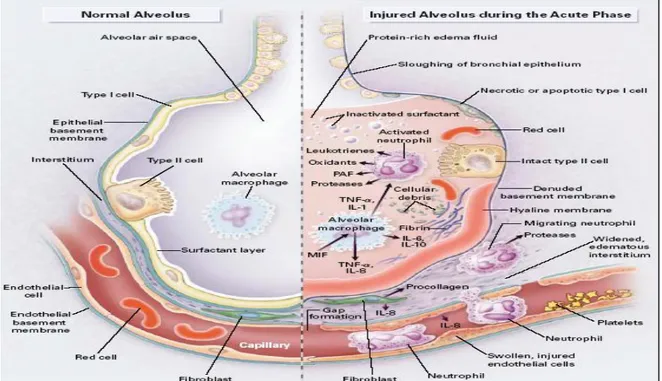 Gambar 2. Keadaan alveoli normal dan alveoli yang mengalami kerusakan saat fase akut  pada ALI dan ARDS  2 