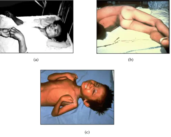 Gambar 3. (a) Risus sardonikus; (b) Opistotonus; (c) Anak penderita tetanus yang menangis akibat kontraksi  otot yang nyeri