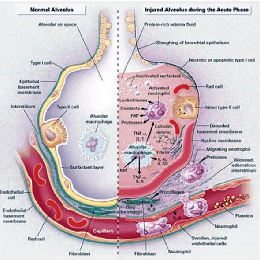 Gambar dibawah ini memperlihatkan gambaran alveolus yang normal dan alveolus yang mengalami  kerusakan akibat ARDS