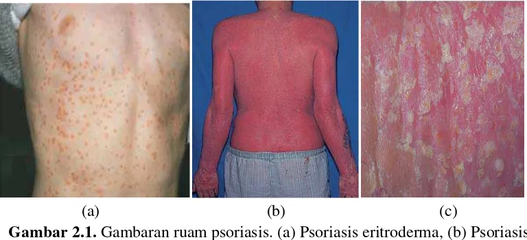 Gambar 2.1. Gambaran ruam psoriasis. (a) Psoriasis eritroderma, (b) Psoriasis 