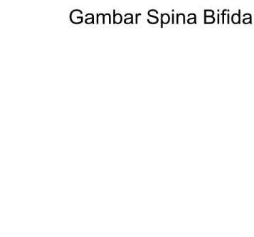 Gambar Spina Bifida