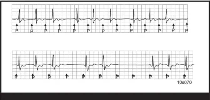 Şekil I ve II’deki EKG örneği olan hastada tanınız nedir?