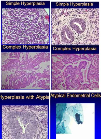 Gambar 3. Klasifikai hiperplasia endometrium