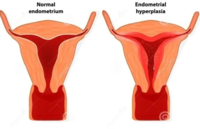 Gambar 1. Hiperplasia endometrium 