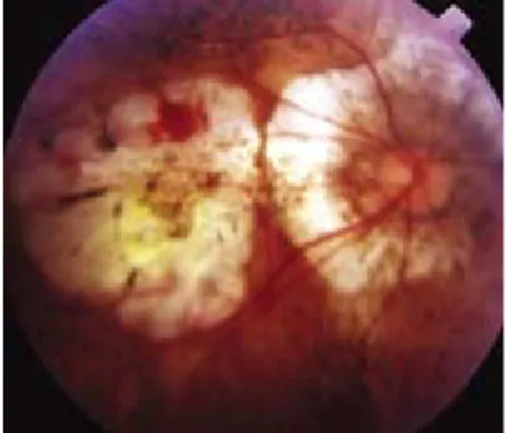 Gambar : Perdarahan subretina dan bercak Fuch’s dari membran neovaskular koroid pada myopia degeneratif.