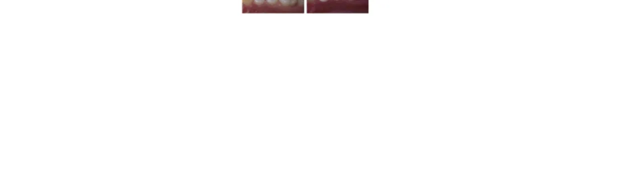 Gambar  2.  Hasil  perawatan  menggunakan  tehnik  restorasi  preventif  resin.  (A)  Gambaran klinis  lesi  karies  pada  gigi  premolar  pertama  rahang  atas  dan  molar  pertama  (sebelum  perawatan), (B) folow up selama 5 tahun menujukkan hasil yang b