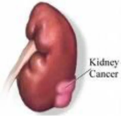 Gambar 1.1 Kanker (tumor) pada ginjal. 