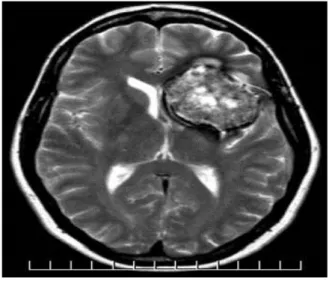 Gambar : CT scan pada AVM 