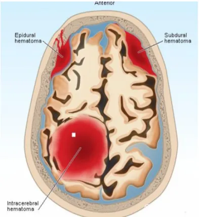 Gambar 2 : Intrakranial Hematoma 5 II.2. EPIDEMIOLOGI 