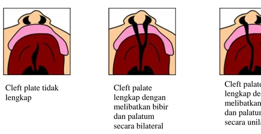 Gambar berikut adalah gambaran secara oklusal dari cleft palate.