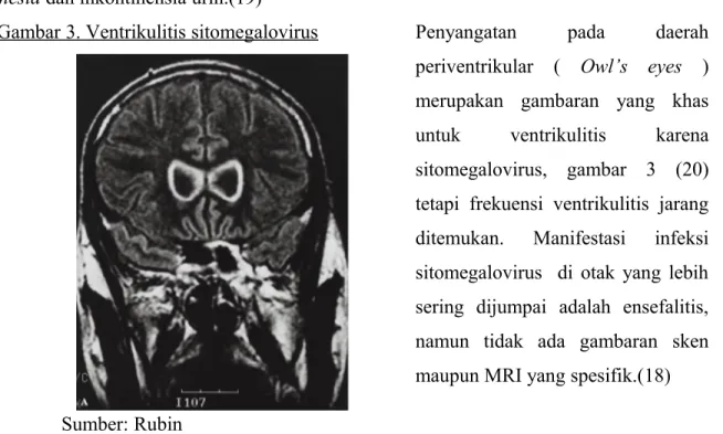 Gambar 3. Ventrikulitis sitomegalovirus
