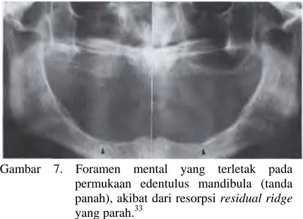 Gambar  7.  Foramen mental yang terletak pada    permukaan edentulus mandibula (tanda  panah), akibat dari resorpsi residual ridge  yang parah