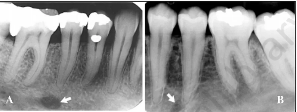 Gambar 8. Foramen mental (tanda panah) A) Terlihat sebagai area  radiolusen yang dekat dengan apeks gigi premolar  kedua