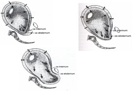 Gambar  14.  Kerja  hidrostatik  selaput  ketuban  untuk  menimbulkan  pendataran  dan  dilatasi  cervix 