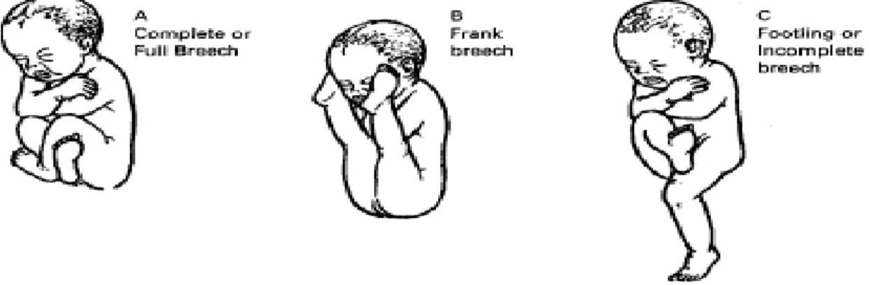 Gambar 6. Presentasi Bokong. (A) Complete Breech, (B) Frank Breech, (C) Footling  atau Incomplete Breech