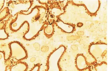 Gambar 1: Histopatologi Glomerulonefritis Membranosa  (Sumber: Orth S.R.&amp; Berhard E., 1998) 