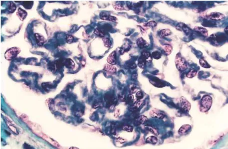 Gambar  2:  Glomerulonefritis  membranoproliferatif,  penipisan  membran  basal  kapiler  perifer telah ditandai dengan pewarnaan trichrome masson