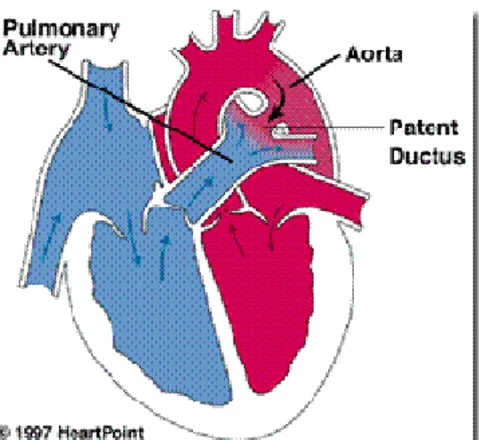 Gambar 5. Patent Ductus Arteriosus