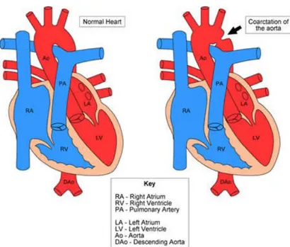 Gambar 2. Coarctatio aorta B. Defect