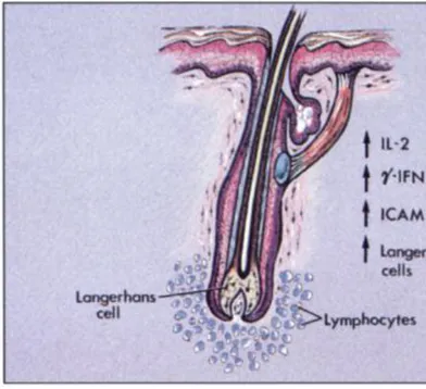 Gambar  3.  Patogenesis  dari  Alopecia areata  2