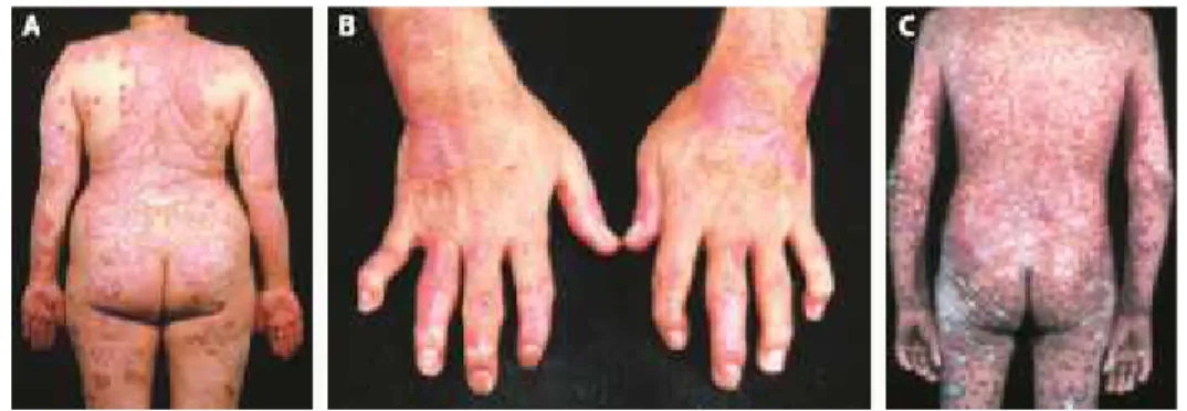 Gambar 2.2 Lesi Klasik Psoriasis 15