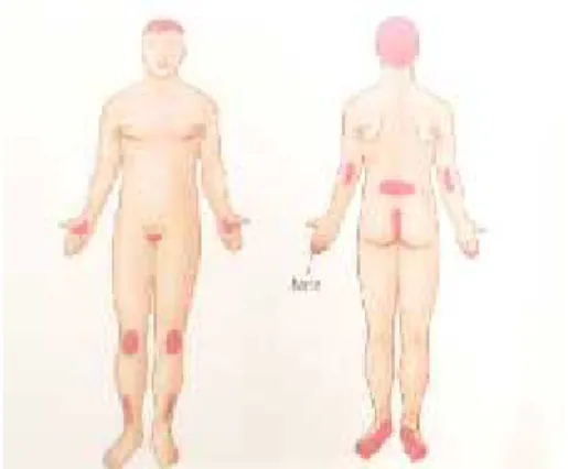 Gambar 2.3 Predileksi Lesi Psoriasis 16