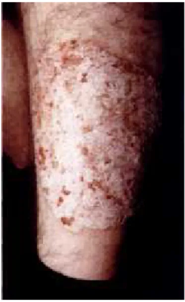 Gambar 2.4 Psoriasis Vulgaris 17