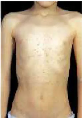 Gambar 2.5 Psoriasis Gutata