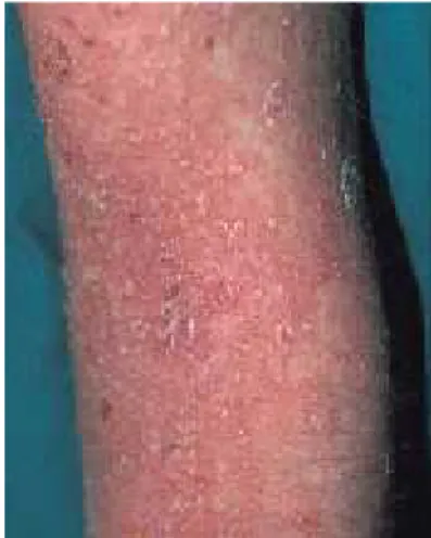 Gambar 2.6 Psoriasis Pustulosa 20