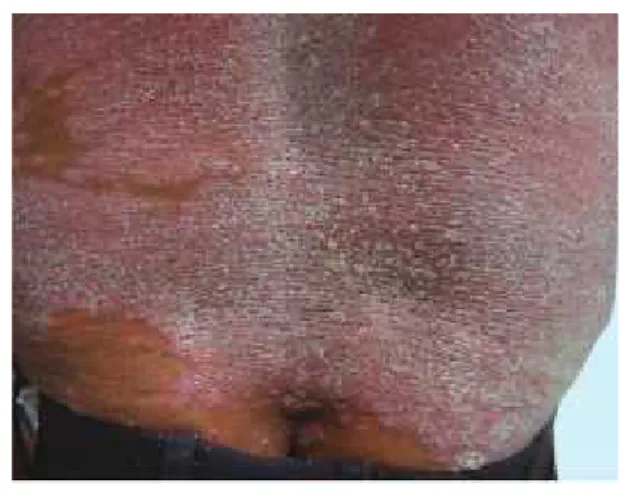 Gambar 2.7 Psoriasis Eritroderma 22