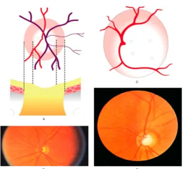 Gambar 4. A dan B. diskus optikus normal. C dan D Early glaukomatous  changes. (dikutip dari kepustakaan 6)