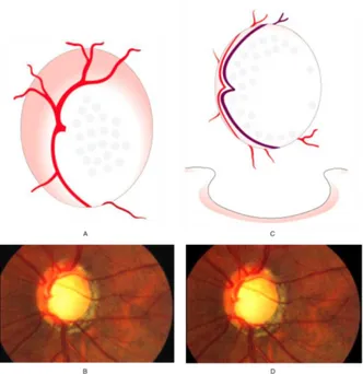 Gambar 5. A dan B. Advanced glaukomatous change.s C dan D. Atrofi  optik glaukomatous