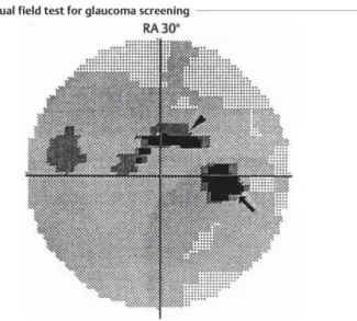 Gambar 11. Early glaukoma. Mata panah menunjukkan adanya defek lapangan  pandang. (dikutip dari kepustakaan 8)