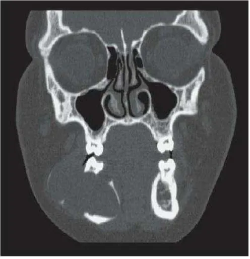 Gambar 10 gambaran CT scan dari pasien yang sama terlihat adanya perluasan tulang kortikal 