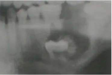Gambar 17. Gambaran radiografi calcifying epitelial odontogenik tumor 