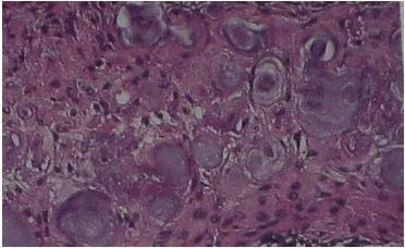 Gambar 18. Gambaran histopatologi calcifying epithelial odontogenik tumor 