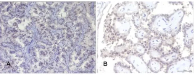 Gambar  2.A.Karsinoma  papiler  dengan  ekspresi  cyclin  D1  skor  +4(imunohistokimia,  200x)