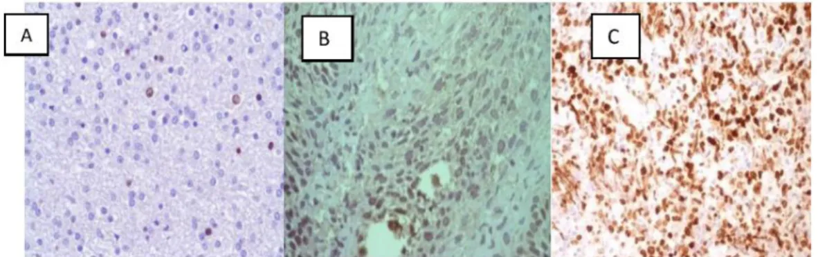 Gambar 1. Pewarnaan imunohistokimia ekspresi protein p53. Immunostaining p53 pada karsinoma sel skuamosa  kepala dan leher