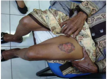 Gambar 1.  Ulkus kronik di paha kiri penderita