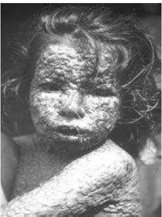 Gambar  Seorang gadis Bangladesh terinfeksi cacar, Sumber: Wikipedia, 2010 