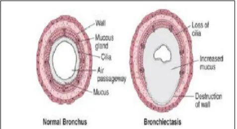 Gambar 3. Gambaran bronkus pada bronkiektasis  (Sumber: Benditt, JO, 2008 ) 
