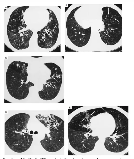 Gambar  10.  Hasil  CT  resolusi  tinggi  pada    gambaran  paru  dengan  bronkiektasis