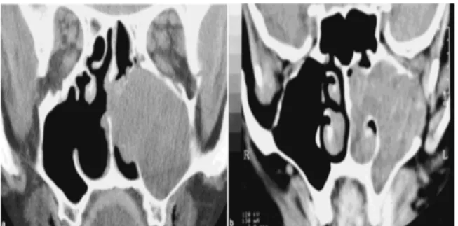 Gambar 3. (a) Kasus 1. CT scan memperlihatkan ameloblastoma pada sinus maxillaris dan cavum nasi.