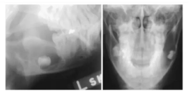 Gambar 4. Odontogenic keratocyst pada anak laki-laki 13 tahun. Kelainan ditemukan secara insidental pada foto radiografi konvensional karena terapi ortodontic