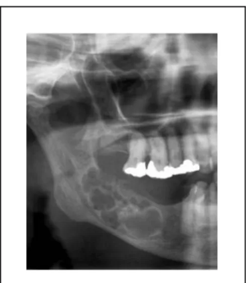 Gambar 9: Multiokular ameloblastoma  (http://www.radpod.org/2007/08/01/ 