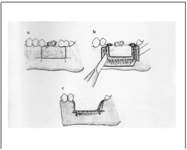 Gambar 11: Eksisi  Blok    (Thoma KH, Vanderveen  JL.  Oral  Surgery.  5 th   Ed.Saint Louis;The C.V